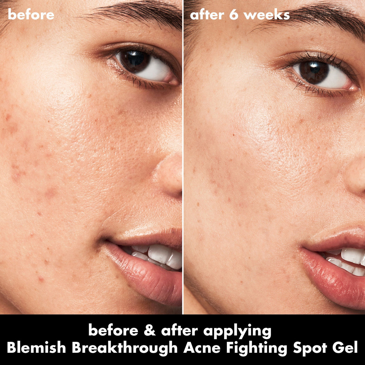 Blemish Breakthrough Acne Fighting Spot Gel