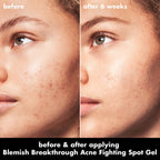 Blemish Breakthrough Acne Fighting Spot Gel