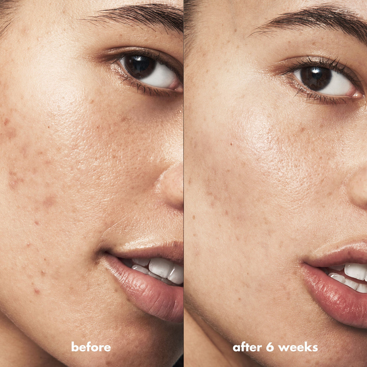 Blemish Breakthrough Acne Calming Water Cream Mini