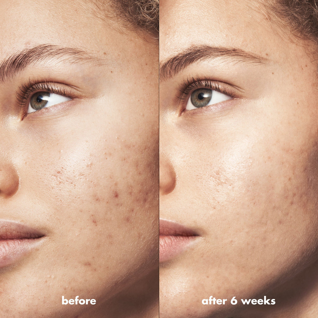 Blemish Breakthrough Acne Calming Water Cream Mini